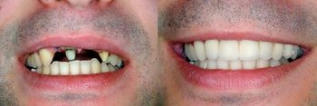 Smile Gallery - Troy Dental, Shorewood Dentist