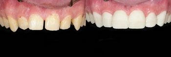 Smile Gallery - Troy Dental, Shorewood Dentist