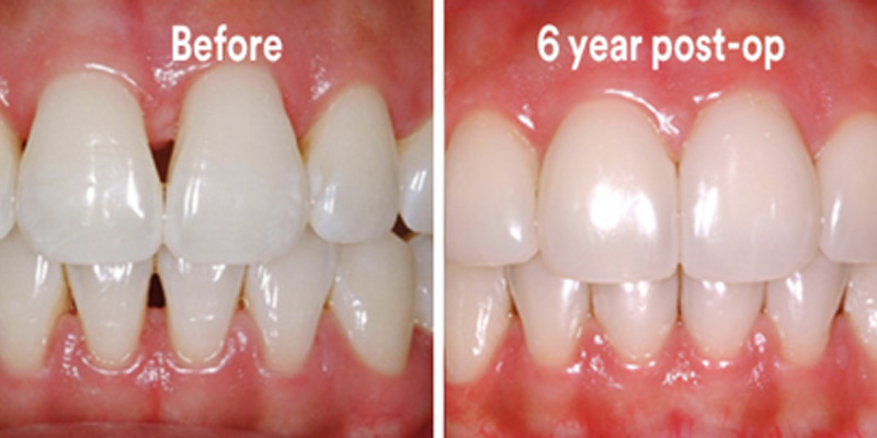 BioClear Diastema Closure and Black Triangle Closure  - Troy Dental, Shorewood Dentist