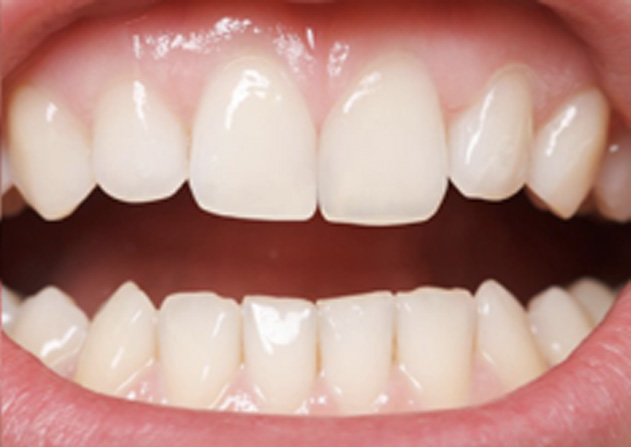 Cosmetic Bonding  - Troy Dental, Shorewood Dentist