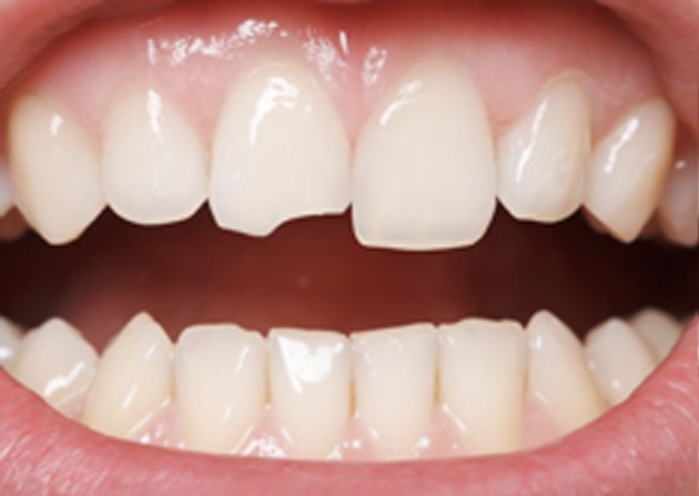 Cosmetic Bonding  - Troy Dental, Shorewood Dentist