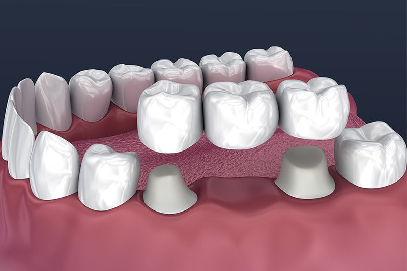 Crowns and Bridges, Inlays and Onlays  - Troy Dental, Shorewood Dentist