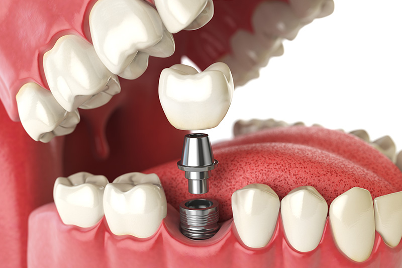 Dental Implants - Troy Dental, Shorewood Dentist