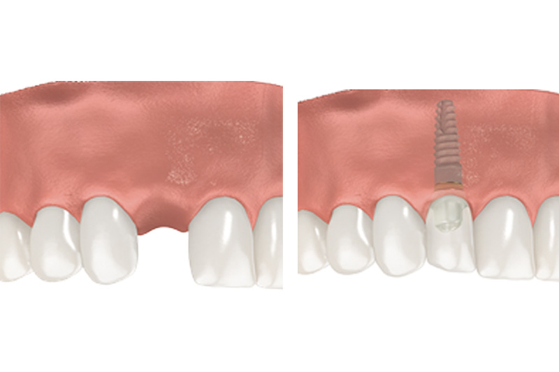 Dental Implants - Troy Dental, Shorewood Dentist