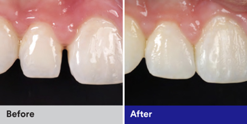 BioClear Diastema Closure and Black Triangle Closure  - Troy Dental, Shorewood Dentist