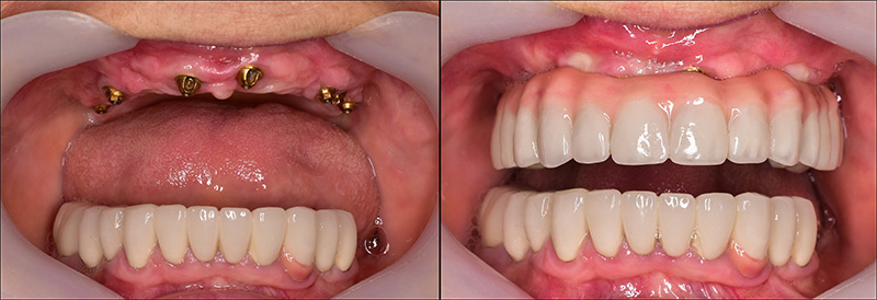 Implant Overdentures and Fixed All-On-X Treatment  - Troy Dental, Shorewood Dentist