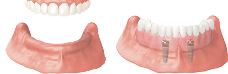 Implant Overdentures and Fixed All-On-X Treatment  - Troy Dental, Shorewood Dentist