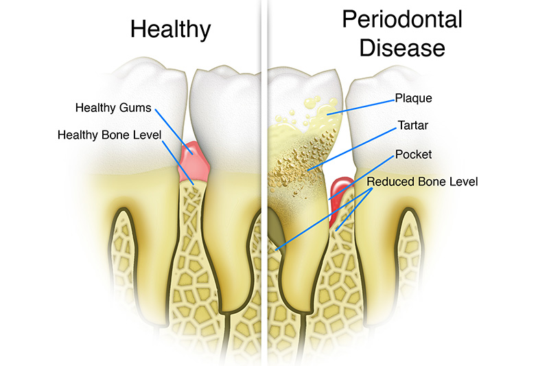 Scaling & Root Planings (Deep Cleanings)  - Troy Dental, Shorewood Dentist