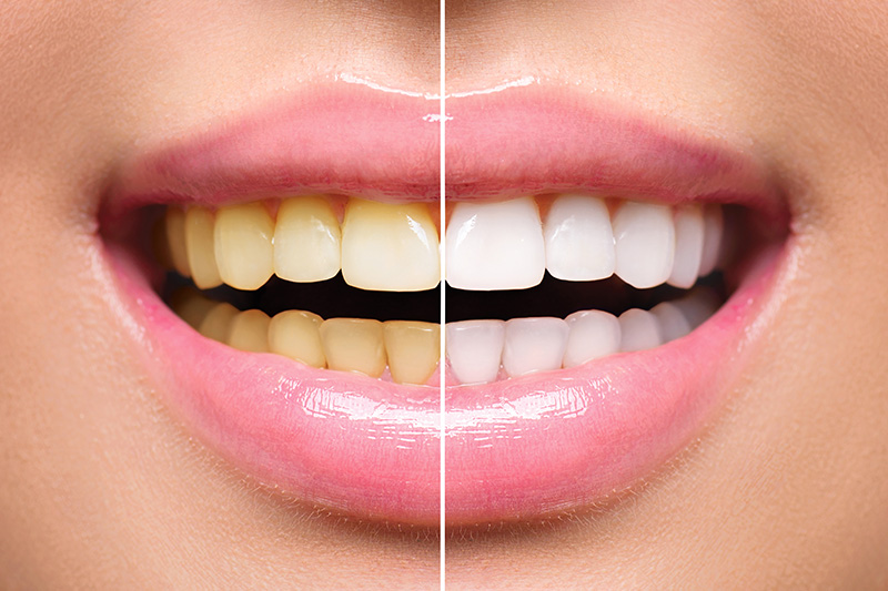 Teeth Whitening - Troy Dental, Shorewood Dentist