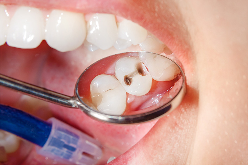 Tooth Colored Composite Fillings  - Troy Dental, Shorewood Dentist