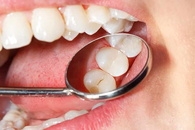 Tooth Colored Composite Fillings  - Troy Dental, Shorewood Dentist