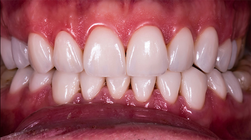 Veneers  - Troy Dental, Shorewood Dentist