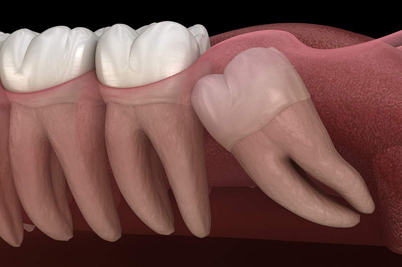 Wisdom Teeth Extractions (with Sedation)  - Troy Dental, Shorewood Dentist